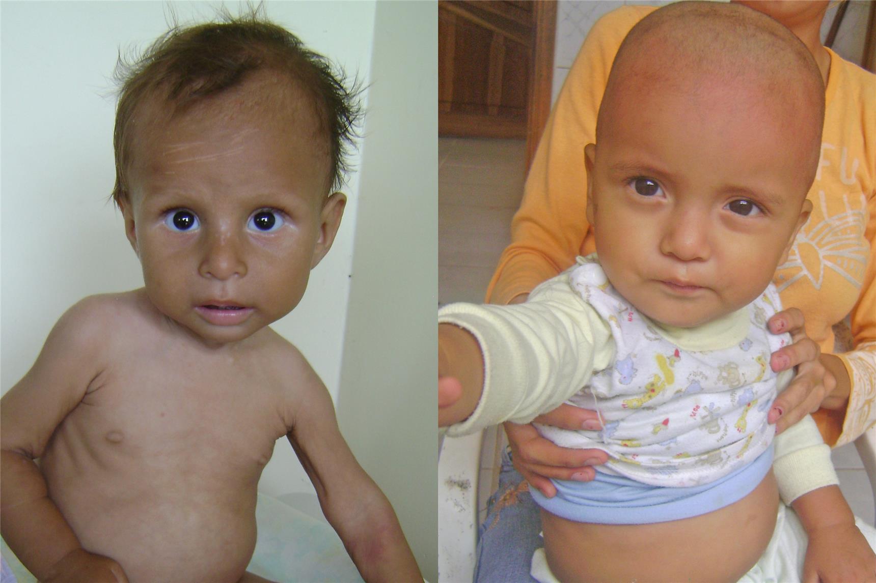 unterernährtes Kind